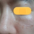 성민전기조명 | 남자 프락셀 턱 보톡스 후기 - (상편)
