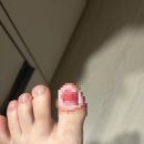 엄지약국 | 엄지발톱 제거수술 후기, 수술비용/경과/케어방법