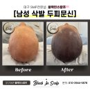 도트인스칼프 이미지