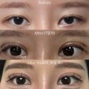 고양이세수 | 내돈내산 매몰 쌍수 (비절개) + 눈매교정 8~14일차 후기 (세수, 화장 시기, 붓기 과정)