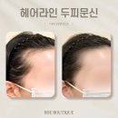 황금지구대 | 반영구 헤어라인 문신 콤보기법 자연스러운 후기 / 광주 이마라인 타투 비대칭 교정