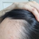 - | 모발이식비용 후기
