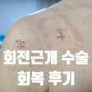 에이스메디칼 | 어깨 회전근개 파열 수술 후 운동, 재활 후기 안산 에이스병원 선택 이유 이용준 원장님