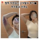 교대 팔뚝 무한 람스 가격 2개월차 솔직 후기(부작용, 만족도)