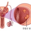 전립선암 이미지