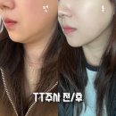 V-1 | 부산 서면 [TT주사 - 윤곽주사, 턱보톡스, V라인주사]1주일차 후기
