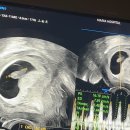 0 주공3차옆 | 대구 마리아 시험관 3차 2일배양 신선이식 성공! 임신초기증상부터 8주 난임병원 졸업까지