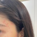 다산지금약국 | [1일차] 직장인 얼굴 편평사마귀 제거 내돈내산 후기(사진 주의)