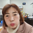 아미스킨 | 대구 콜드 플라즈마 블라스트 메디컬 스킨케어 토탈뷰티샵 아미뷰티 하안검 솔직 후기