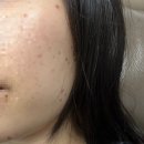 선릉역 힐비뇨기과 잡티제거 후기｜예약 방법·가격·레이저 종류까지 총정리