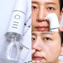 피지제거기 압출기 흡입기 추천 뷰티캐처 아쿠아필링기 포어쿨 후기