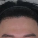185 | [대다모 포토후기] 30대 남성 3000모 모발이식 185일 후기입니다.