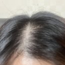 정수리 | 여성탈모 극복 정수리 탈모 관리 후기