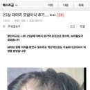 25살 머머리 모발이식 후기 이미지