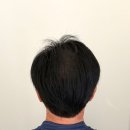 스칼프디자인센터 | 울산두피 고민으로 찾은 모마인드 스칼프 디자인센터 광범위 밀도 보완 후기