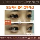 [부산필러 잘하는곳/부산 서면필러]연예인 얼굴 부산애교필러 가격/후기~ 이미지