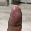 남천한의원 | 농포증 치료 후기