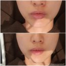 강남벨라의원 | 강남역인모드 강남벨라의원 1회차 후기