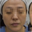 모공 팔자주름 치료 효과 쥬베룩 볼륨 한병의 기적 시술 후기 (ft 트리필프로, 포텐자 펌핑팁, 피코...