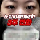 강남신경과의원 | 강남 눈밑지방재배치가격 부담 없는 레이저눈밑지방제거 솔직 후기