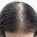 BEGIN HAIR | 은평구탈모치료, 리제네라액티바 가장 많이 묻는 질문 FAQ (가격, 효과, 부작용, 후기)