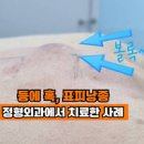 머리에 혹 났을 때 뒷 뒤통수혹 통증 원인 양성종양 제거 치료 이미지