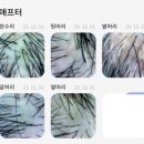 강동-길동-3040 | [공지] ​강동구 남자 M자 탈모 초기, 약 먹기 전 관리로 방어한 30대 직장인 후기 (성내동 리보)