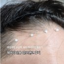 이가한의원 | 탈모예방해주는 이문원 탈모연고 M자 헤어라인에 사용해본 후기