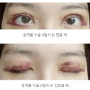 남안과의원 | 대전 신안과 쌍수 후기 1편