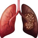 폐암 이미지