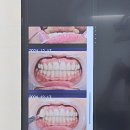 검단치과 미백치료후기