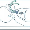 Neonatal Resuscitation Program: Use of the Laryngeal Mask Airway 이미지