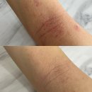 아토피 피부태선화 한포진 습진 완정닷컴 완정앱솔루트리페어링크림 + 아토피상담