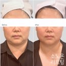 (주)리얼시스템코리아 | ［논현동피부관리］ 소노온코리아에서 받은 소노온리프팅 + 소노웨이브 복합 케어 리얼 후기