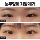 지방 | 신사역 눈두덩이지방제거 수술 후기