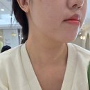 안*일 - 안양시 만안구 양화로222번길 | 대구 인모드리프팅 솔직후기/ 일주일안에 턱라인 달라졌어요!