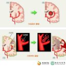 I63에 해당하는 상병의 뇌경색증 환자가 증상 발생 24시간 이내에 병원에 도착하여 입원진료중 NIHSS가 5점이상인 경우 최대 30일 이미지