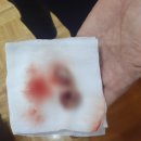 석전동247 | 마산예일이비인후과 입원 편도절제술 후기 음식 목넘김 통증 1일~5일차