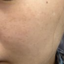 759 | 깨순이의 주근깨 터는 날 / 압구정 피부과 루비레이저 내돈내산 주근깨 시술 후기 / 759방 / 3개월 이후