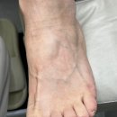 상남대동아파트경로당 | [하이푸스 상남점] 창원 상남동 무좀관리 | 창원내성발톱 스케일링으로 아기발 된 후기