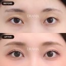 플랜에이성형외과의원 | [20대 눈재수술 후기] 졸린 눈 안검하수, 절개 눈매교정으로 해결한 리얼 사례 | 드라마성형외과
