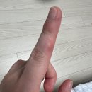 성인 수족구 증상, 병원, 치료 후기