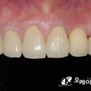 오케이라인치과의원 | 의왕 오전동치과, 부러지고 썩은 앞니... 발치와 동시에 임플란트로 해결한 후기 (60대 여성)