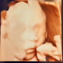 백아면 아산중기 앞 | [임신] 21w3d 아산병원 정밀초음파 검진 후기 (원혜성교수님, 결과, 비용, 수술일예약)