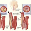 경동맥 협착증[carotid artery stenosis]이란? 이미지