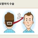 광주모발이식, 광주탈모, 건강한 토크쇼