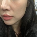 벌써 세번째 방문 구월동피부과 리쥬란 바이리즌 스킨부스터 3CC 내돈내산 후기