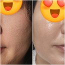 큐티1 | 선정릉피부과 큐티셀 스킨부스터 프락셀로 모공 피부결 효과 후기
