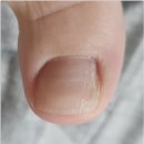 광주 금호동 내성발톱 확실하게 개선하고 싶다면 뷰티업라이프 페디네일 광주본점