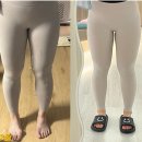 분당 허벅지 람스후기 전후 변화와 통증·붓기·회복 과정